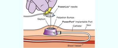 Catéter con puerto: lo mejor para un tratamiento IV prolongado.