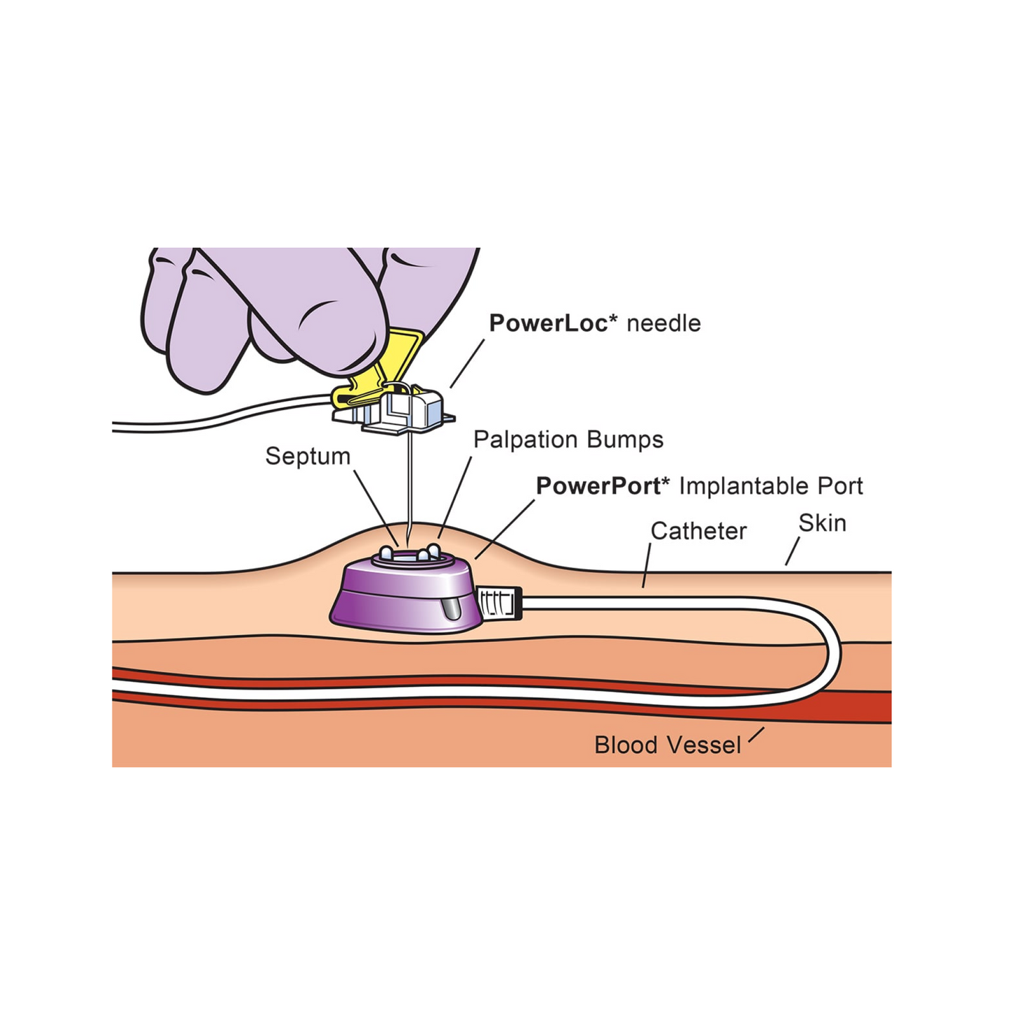 PowerPort™  isp M.R.I. Puerto Implantable